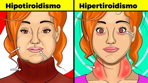 hipertiroidismo síntomas - salmonella síntomas